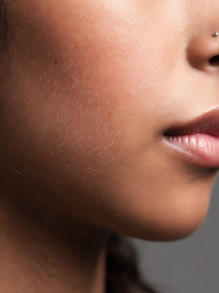 Dermaplaning